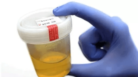 Urine Changes Can Signal Kidney Problems: What to Watch For